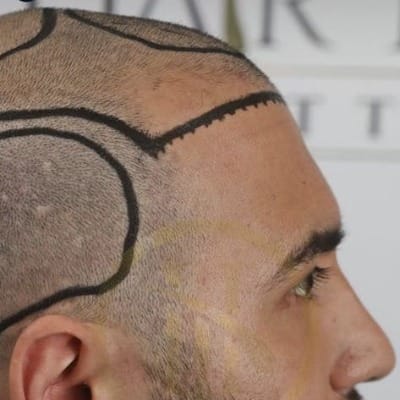 Can I Combine A Hairline and Crown Hair Transplant