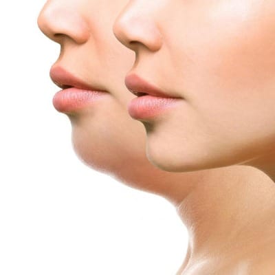 Can laser treatment effectively reduce a double chin?