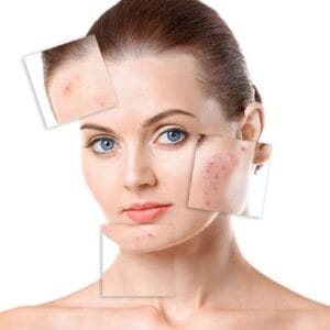 How Can glutathione treat acne scars or blemishes?