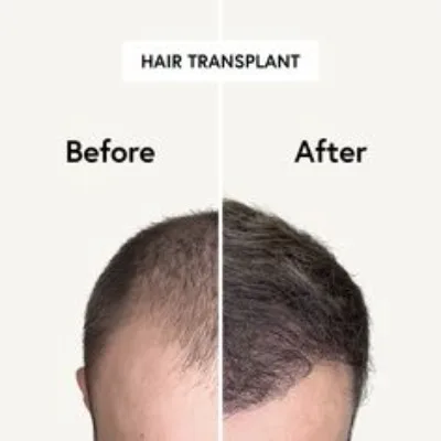Is Hair Transplant Safe in Islamabad Clinics?
