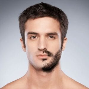 Can Hair Transplants Be Done on Beards?