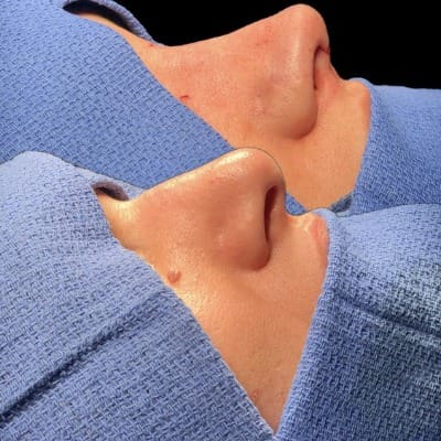 What are the top reasons for rhinoplasty in Islamabad