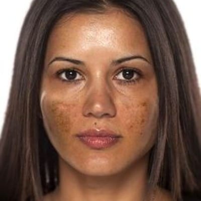What treatment is best for hyperpigmentation?
