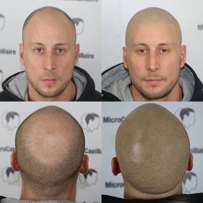 Are Hair Transplants Safe for Older Patients