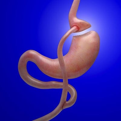 Can I have bariatric surgery if I have diabetes
