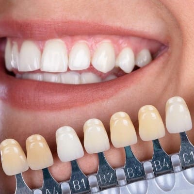 Do composite veneers look natural
