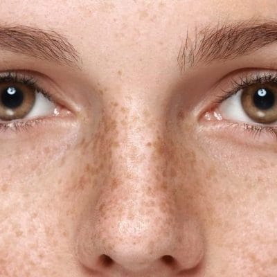 Effective Treatments for Hyperpigmentation in Islamabad