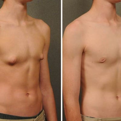 How To Get Rid Of Gynecomastia During Puberty