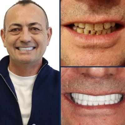 Mandibular Implants in Islamabad