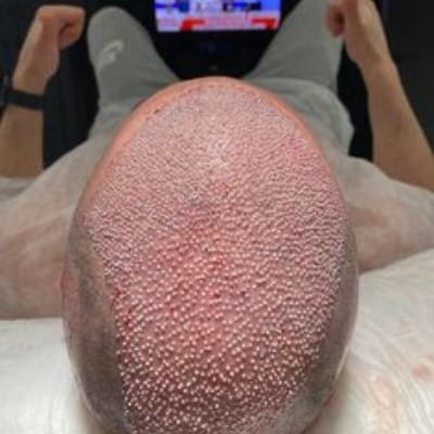 Results of Hair Transplant in Islamabad, Pakistan