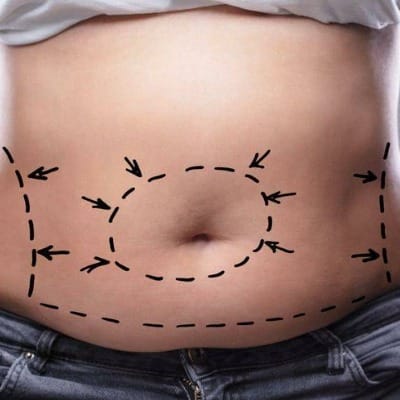 Slim Down Safely with Liposuction in Islamabad