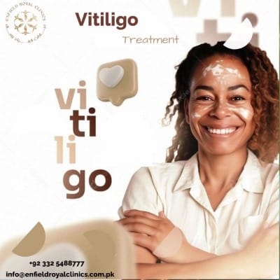 Vitiligo Treatment in Islamabad, Pakistan