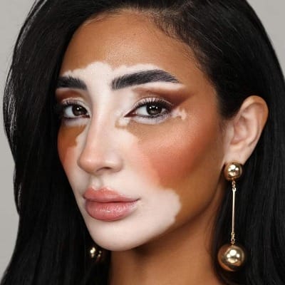 What Is Vitiligo and How Does It Affect the Skin