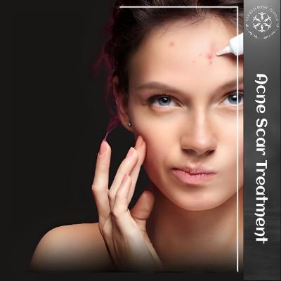 Acne Scar Treatment in Islamabad Pakistan - ERCs