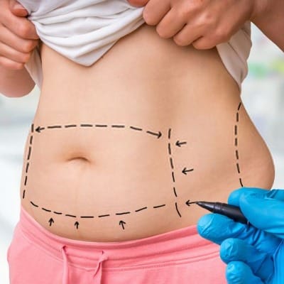 Expert Surgeon for Tummy Tuck in Islamabad