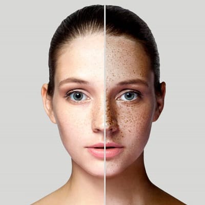 How Much Do Freckles and Blemishes Removal Cost in Islamabad?