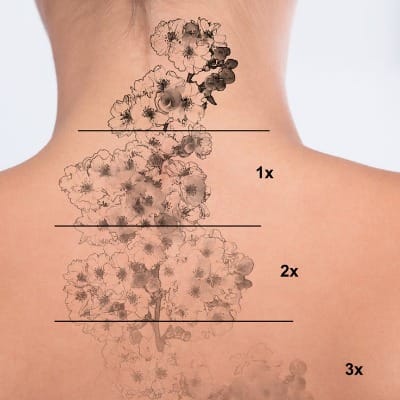 How Much Does Laser Tattoo Removal Cost in Pakistan
