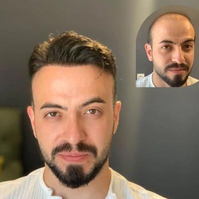 How Much Hair is 2000 Grafts in Islamabad