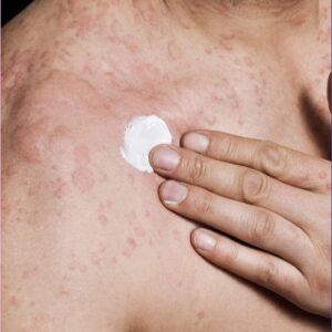 Is it safe to exfoliate when I have hives