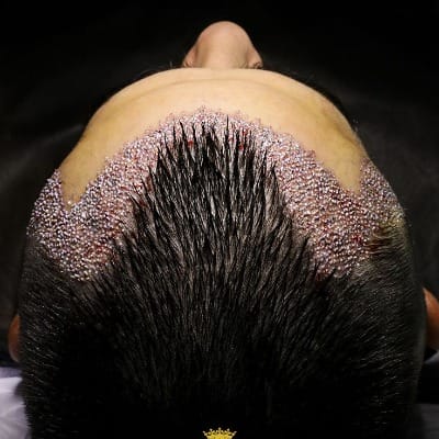 Most Famous Hair Transplant Clinic in Pakistan