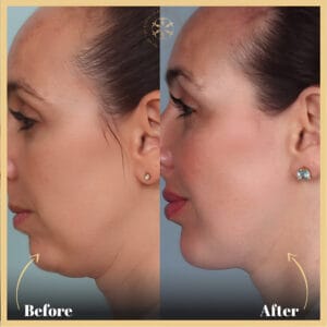 Neck lift treatment in Islamabad