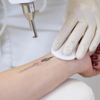 Picosure Tattoo Remova in Islamabad
