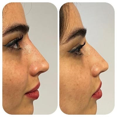 Septorhinoplasty In Islamabad Pakistan Price