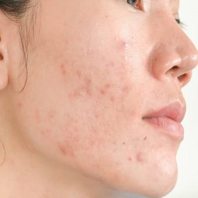 Specific treatments for ice pick scars
