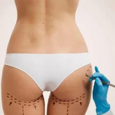 Butt Fillers in Islamabad