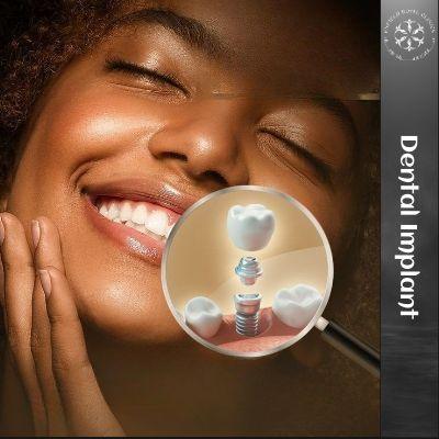 Dental Implant in Islamabad
