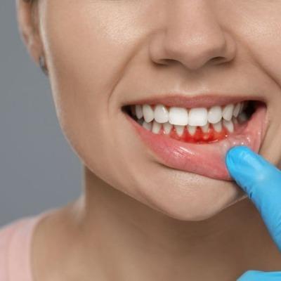 Gum Recontouring Treatment Cost in Islamabad