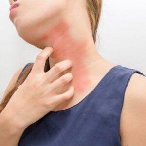 How Much Does Hives Treatment Cost in Islamabad