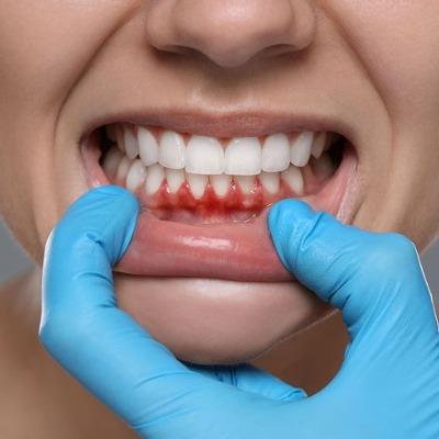 How Much Will Gum Grafting Cost at Your Dental Clinic?