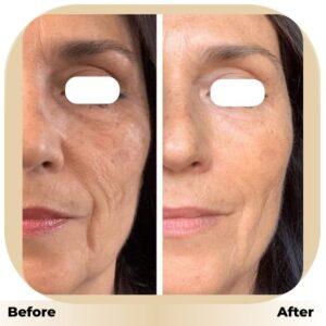 Hyaluronic Acid