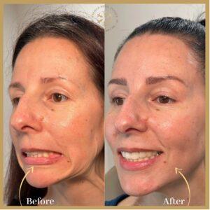 Nefertiti Lift Treatment in Islamabad