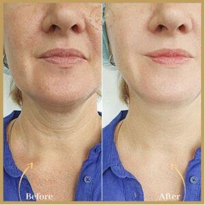 Nefertiti Lift Treatment in Islamabad