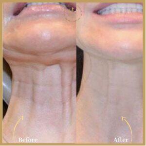 Nefertiti Lift Treatment in Islamabad