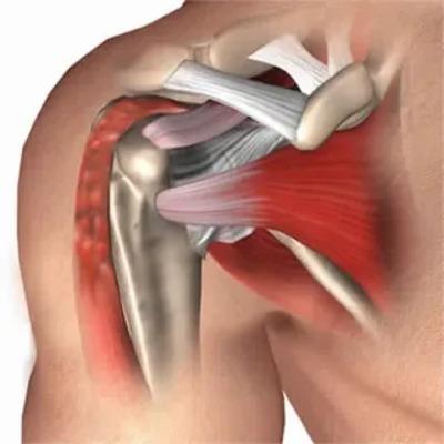 Subacromial Decompression in Islamabad