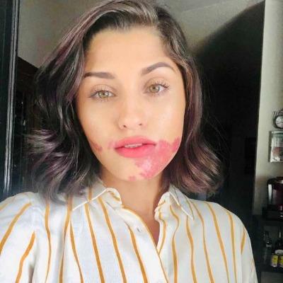 What Is the Price of Port Wine Stains Treatment