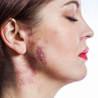 What is the Cost of Port Wine Stain Treatment