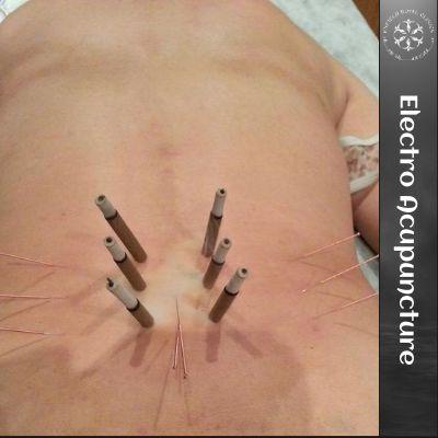 Electro Acupuncture in Islamabad