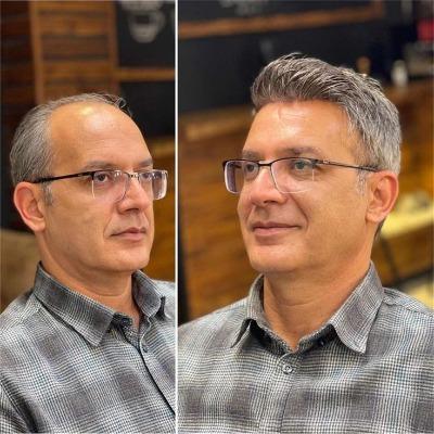 What Is the Cost of Non-Surgical Hair Replacement
