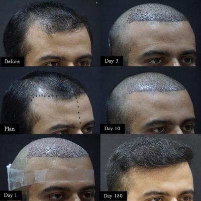 10000 graft hair transplant cost in Pakistan
