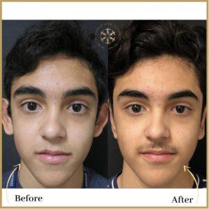 Ear Reshaping ( Otoplasty) in Islamabad