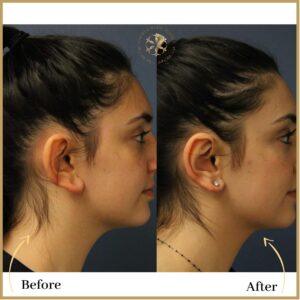 Ear Reshaping ( Otoplasty) in Islamabad