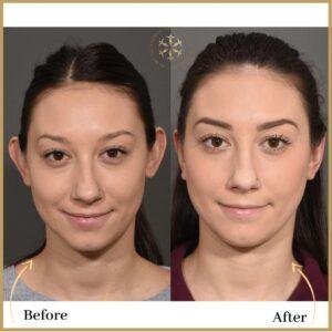 Ear Reshaping ( Otoplasty) in Islamabad