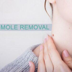 How Is Laser Mole Removal Different from Radiofrequency Ablation
