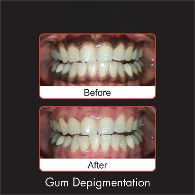 Is Gum Depigmentation in Islamabad Painful or Completely Comfortable
