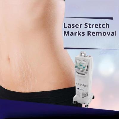 Is Laser the Best Option for Stretch Mark Removal in islamabad