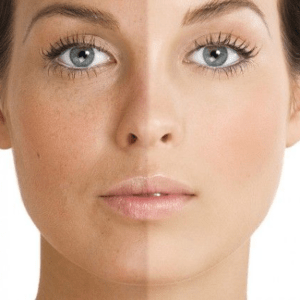Skin Toning Treatment- Fact or Fiction